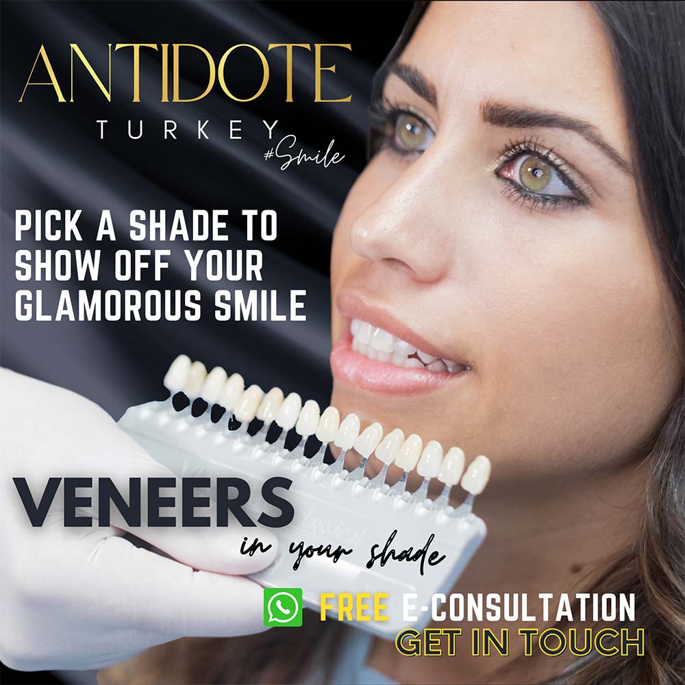 Veneers V1 - 2